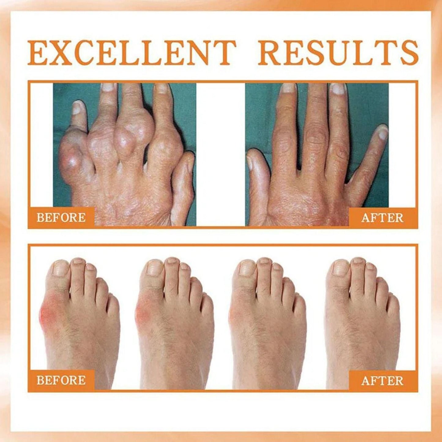 Bee Venom Beesae Arthritis Spray 100ML - Natural Pain Relief